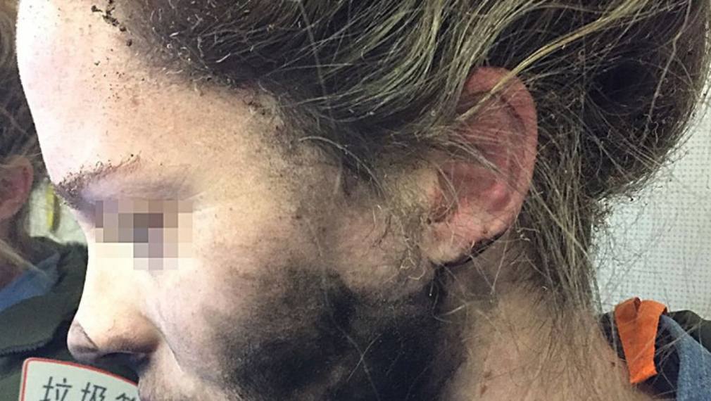 Жена пострада, след като слушалките й избухнаха