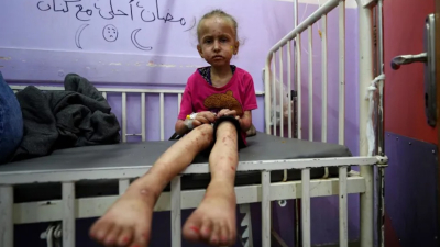 Най малко 3000 палестински деца са загубили крайници в резултат на
